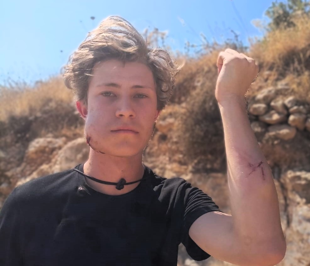 إصابة مواطن ومتضامن أجنبي إثر اعتداء للمستعمرين في قصرة جنوب نابلس