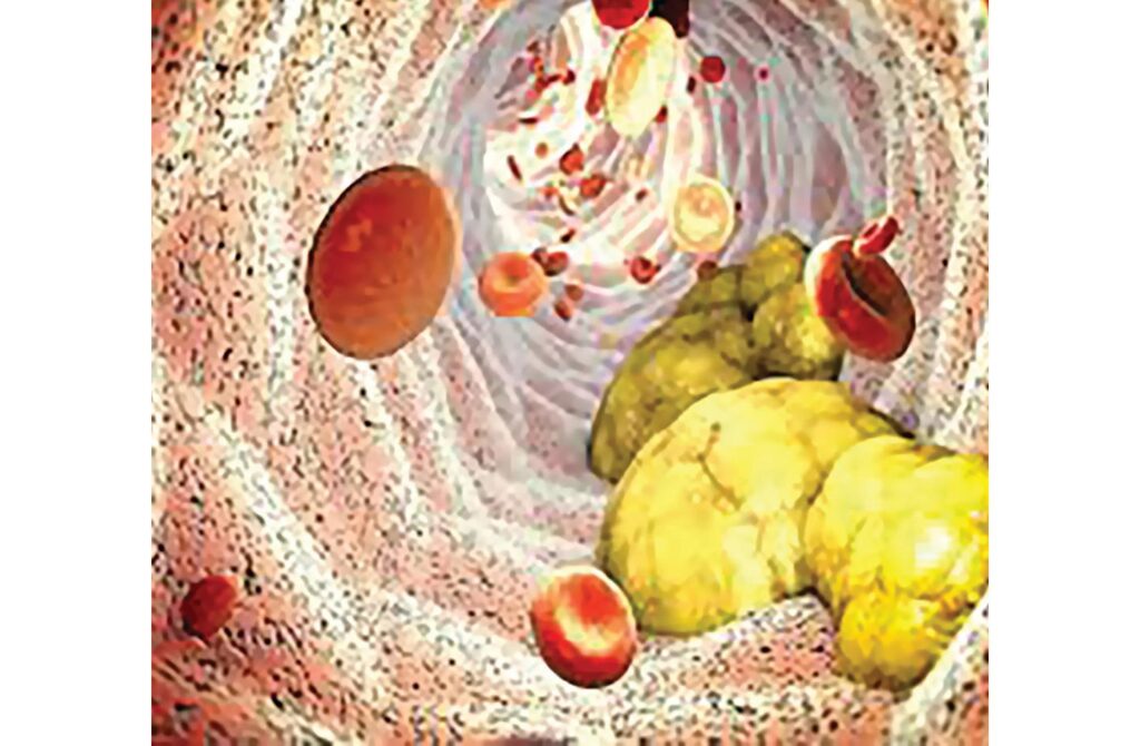 دهون مخفية تمثل قنبلة موقوتة.. وقد تؤدي للوفاة بأي لحظة