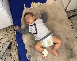 35 حالة حمى شوكية بين الأطفال في مجمع ناصر بخانيونس