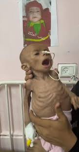 وفاة رضيع نتيجة سوء التغذية ونقص حليب الأطفال في غزة