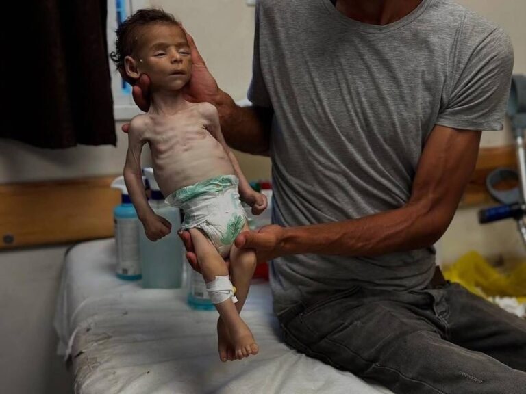 ارتفاع شهداء التجويع في غزة الى 251 بينهم 108 أطفال