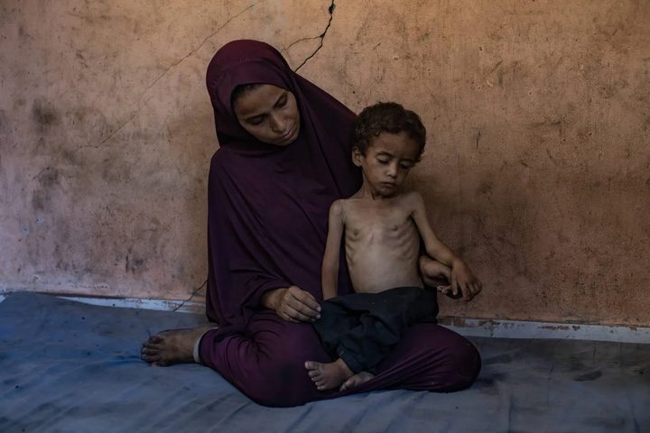 وفاة طفلة بسبب المجاعة وسوء التغذية في قطاع غزة