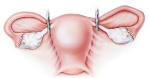 طريق المحبة/ استئصال الرحم… بين ضرورة العلاج وتحديات ما بعد العملية